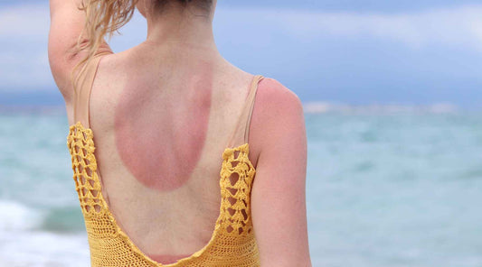 Comment réparer la barrière cutanée endommagée après une exposition au soleil